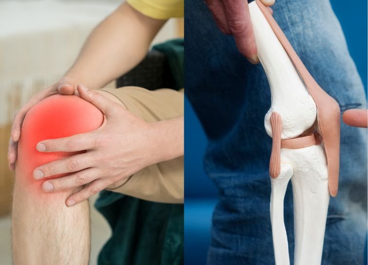 chondromalacia patella in India