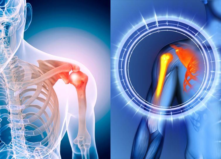 Shoulder Impingement in India
